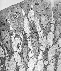 jejunum … lipid malabsorption jejunum … lipid malabsorption